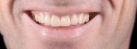 Odontología: ¿Alineación con ortodoncia o diseño de sonrisa con coronas?
