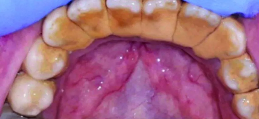 Prevenir la formación de sarro dental