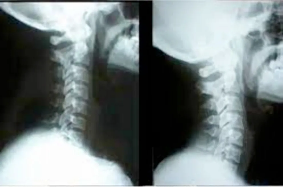 Rectificacion cervical