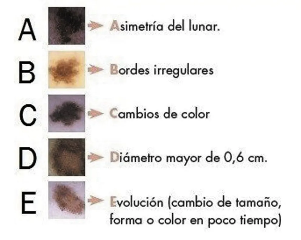 Campaña Nacional De Prevención del Cáncer de Piel